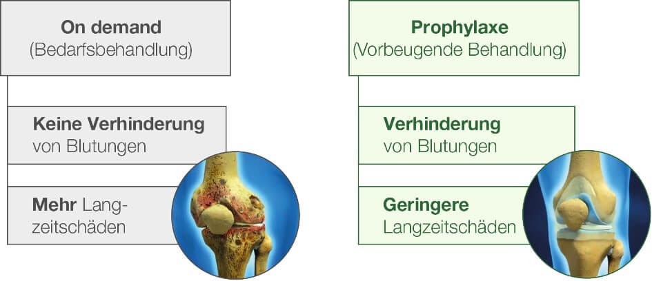 Vergleich der Gelenke mit und ohne Haemophilieprophylaxe